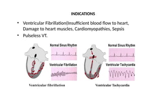 Ventricular fibrillation
INDICATIONS
• Ventricular Fibrillation(Insufficient blood flow to heart,
Damage to heart muscles, Cardiomyopathies, Sepsis
• Pulseless VT.
Ventricular Tachycardia
 