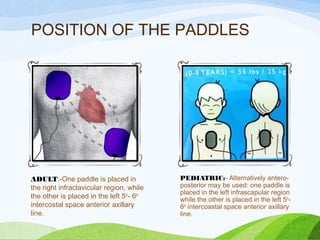 POSITION OF THE PADDLES
ADULT:-One paddle is placed in
the right infraclavicular region, while
the other is placed in the left 5th
- 6th
intercostal space anterior axillary
line.
PEDIATRIC:- Alternatively antero-
posterior may be used: one paddle is
placed in the left infrascapular region
while the other is placed in the left 5th
-
6th
intercoastal space anterior axillary
line.
 
