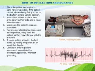 1. Place the patient in a supine or
semi-Fowler's position. If the patient
cannot tolerate being flat, you can do
the ECG in a more upright position.
2. Instruct the patient to place their
arms down by their side and to relax
their shoulders.
3. Make sure the patient's legs are
uncrossed.
4. Remove any electrical devices, such
as cell phones, away from the
patient as they may interfere with the
machine.
5. If you're getting artifact in the limb
leads, try having the patient sit on
top of their hands.
6. Causes of artifact: patient
movement, loose/defective
electrodes/apparatus, improper
grounding.
HOW TO DO ELECTROCARDIOGRAPHY
An ECG with artifacts.
Patient, supine position
 