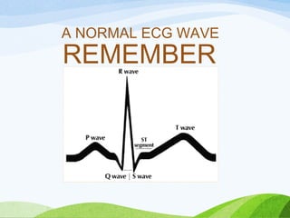 A NORMAL ECG WAVE
REMEMBER
 