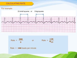 CALCULATING RATE
300
Rate =
For example:
3
150
015
Rate =or
Rate = 100 beats per minute
 