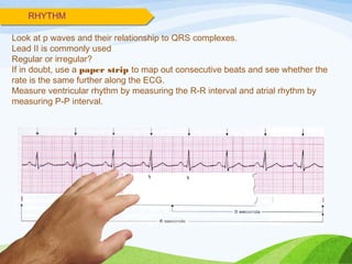 Look at p waves and their relationship to QRS complexes.
Lead II is commonly used
Regular or irregular?
If in doubt, use a paper strip to map out consecutive beats and see whether the
rate is the same further along the ECG.
Measure ventricular rhythm by measuring the R-R interval and atrial rhythm by
measuring P-P interval.
RHYTHM
 