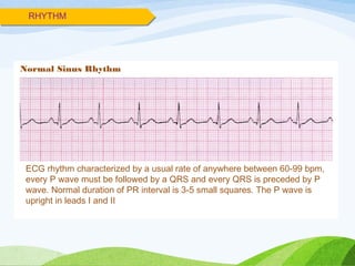 RHYTHM
ECG rhythm characterized by a usual rate of anywhere between 60-99 bpm,
every P wave must be followed by a QRS and every QRS is preceded by P
wave. Normal duration of PR interval is 3-5 small squares. The P wave is
upright in leads I and II
Normal Sinus Rhythm
 