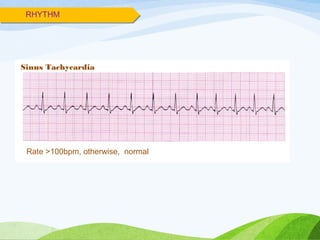 RHYTHM
Sinus Tachycardia
Rate >100bpm, otherwise, normal
 
