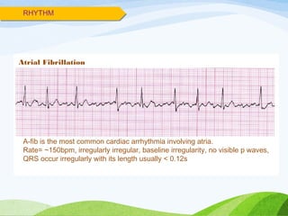 RHYTHM
Atrial Fibrillation
A-fib is the most common cardiac arrhythmia involving atria.
Rate= ~150bpm, irregularly irregular, baseline irregularity, no visible p waves,
QRS occur irregularly with its length usually < 0.12s
 