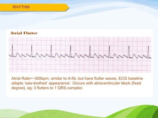RHYTHM
Atrial Flutter
Atrial Rate=~300bpm, similar to A-fib, but have flutter waves, ECG baseline
adapts ‘saw-toothed’ appearance’. Occurs with atrioventricular block (fixed
degree), eg: 3 flutters to 1 QRS complex:
 