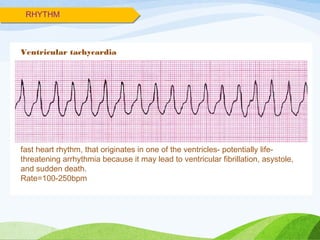 RHYTHM
Ventricular tachycardia
fast heart rhythm, that originates in one of the ventricles- potentially life-
threatening arrhythmia because it may lead to ventricular fibrillation, asystole,
and sudden death.
Rate=100-250bpm
 