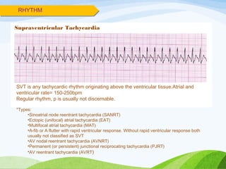 RHYTHM
Supraventricular Tachycardia
SVT is any tachycardic rhythm originating above the ventricular tissue.Atrial and
ventricular rate= 150-250bpm
Regular rhythm, p is usually not discernable.
*Types:
•Sinoatrial node reentrant tachycardia (SANRT)
•Ectopic (unifocal) atrial tachycardia (EAT)
•Multifocal atrial tachycardia (MAT)
•A-fib or A flutter with rapid ventricular response. Without rapid ventricular response both
usually not classified as SVT
•AV nodal reentrant tachycardia (AVNRT)
•Permanent (or persistent) junctional reciprocating tachycardia (PJRT)
•AV reentrant tachycardia (AVRT)
 