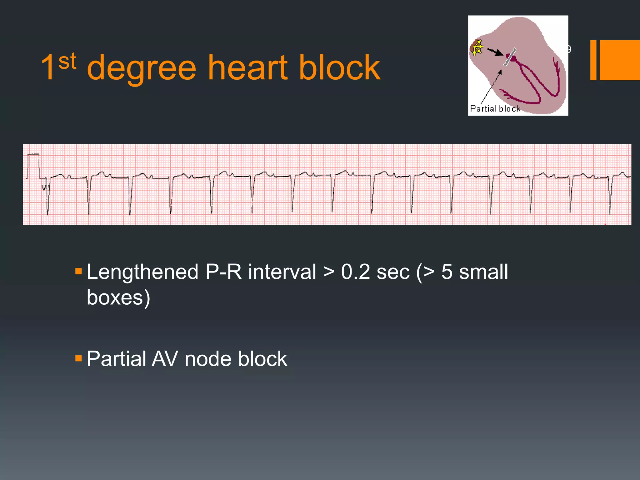 1st degree heart block
Lengthened P-R interval > 0.2 sec (> 5 small
boxes)
Partial AV node block
19
 