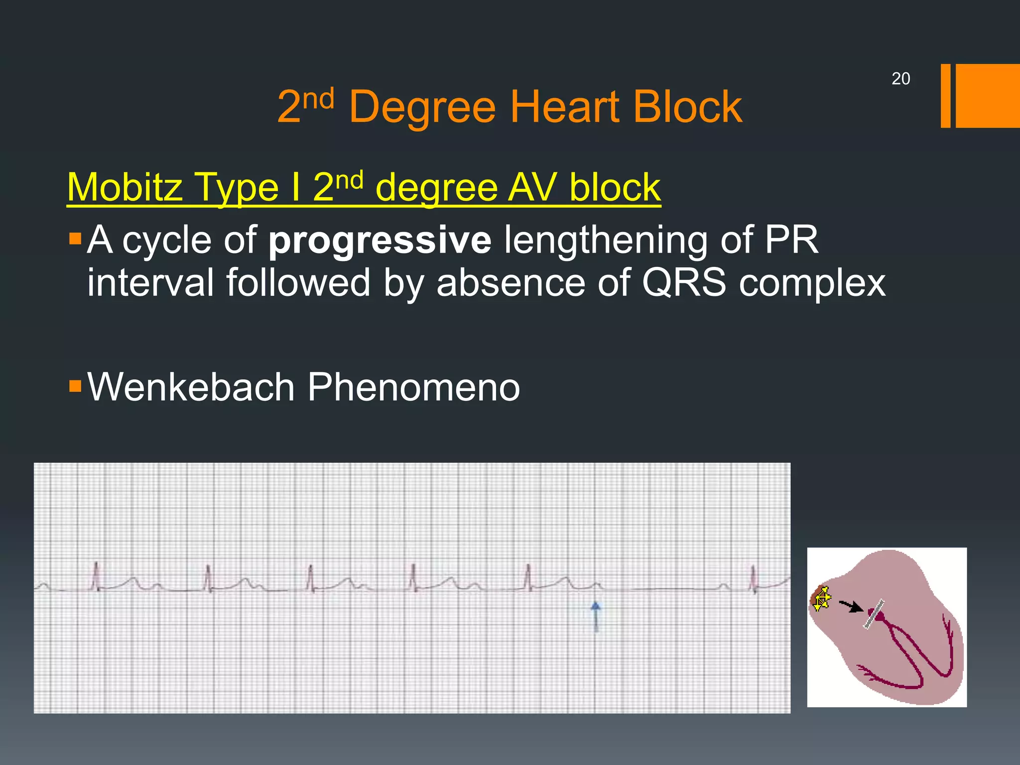 2nd Degree Heart Block
Mobitz Type I 2nd degree AV block
A cycle of progressive lengthening of PR
interval followed by absence of QRS complex
Wenkebach Phenomeno
20
 