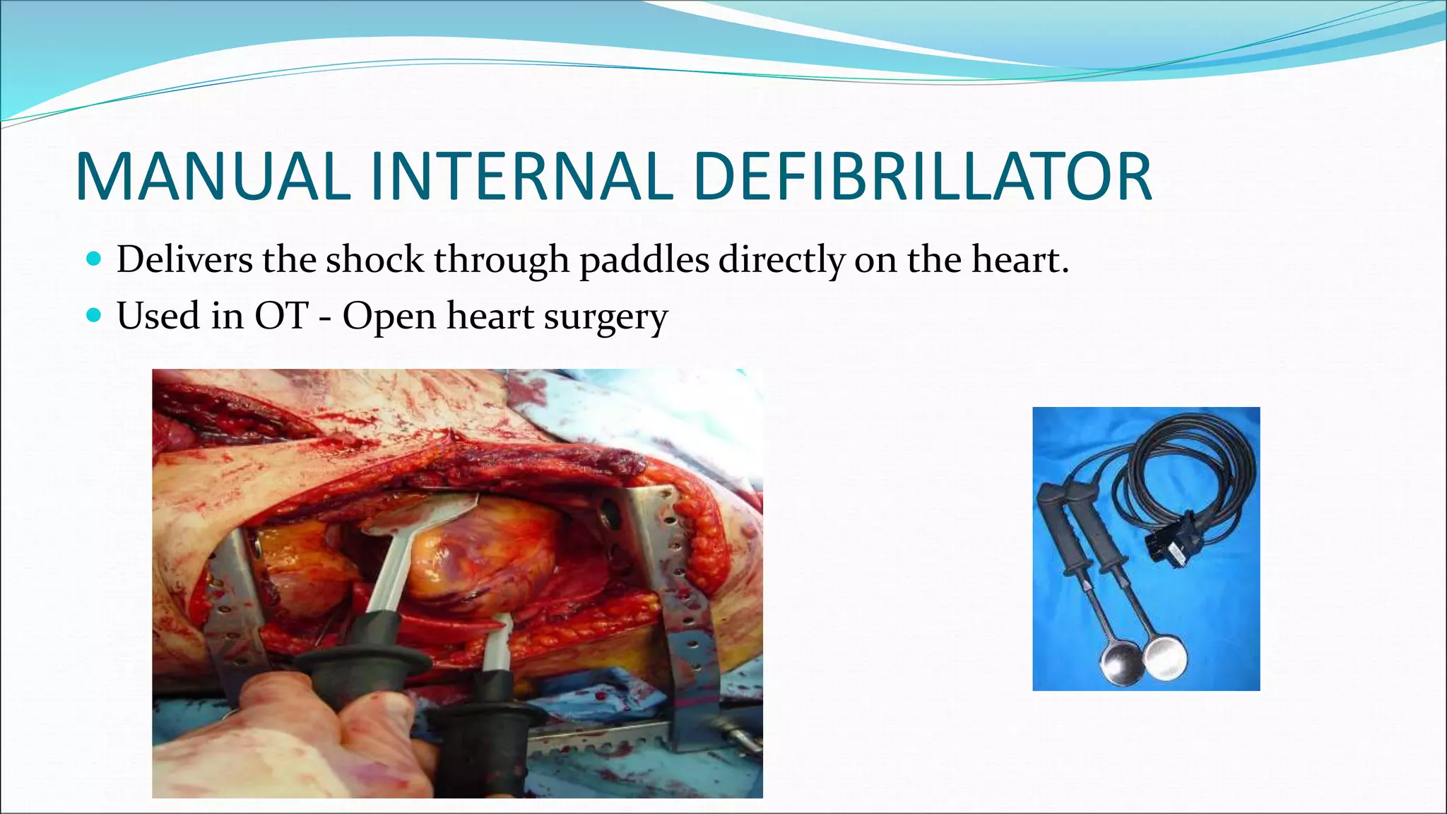 MANUAL INTERNAL DEFIBRILLATOR
 Delivers the shock through paddles directly on the heart.
 Used in OT - Open heart surgery
 
