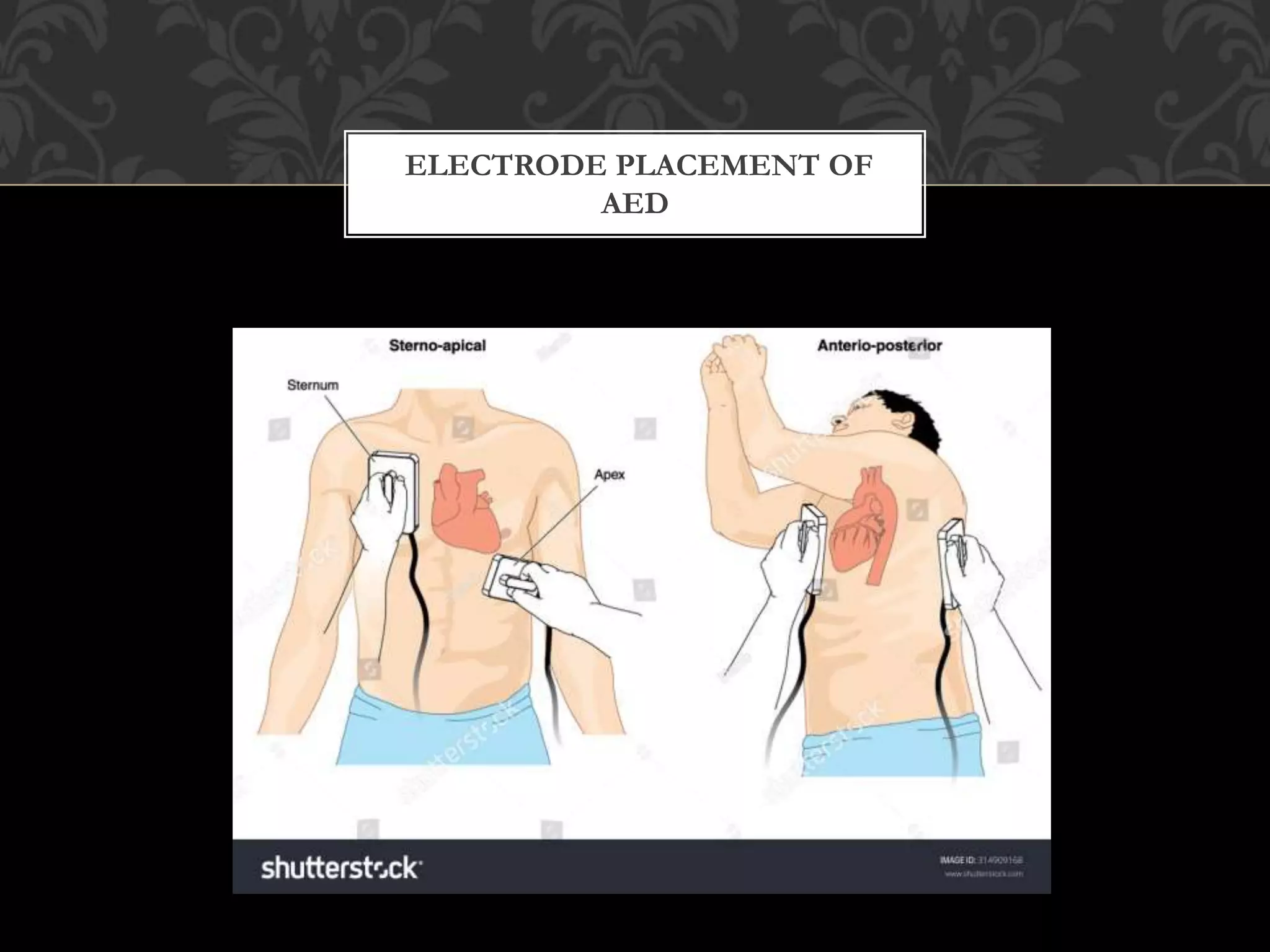 ELECTRODE PLACEMENT OF
AED
 