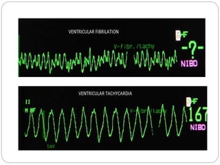 Defibrillator prakash | PPTX