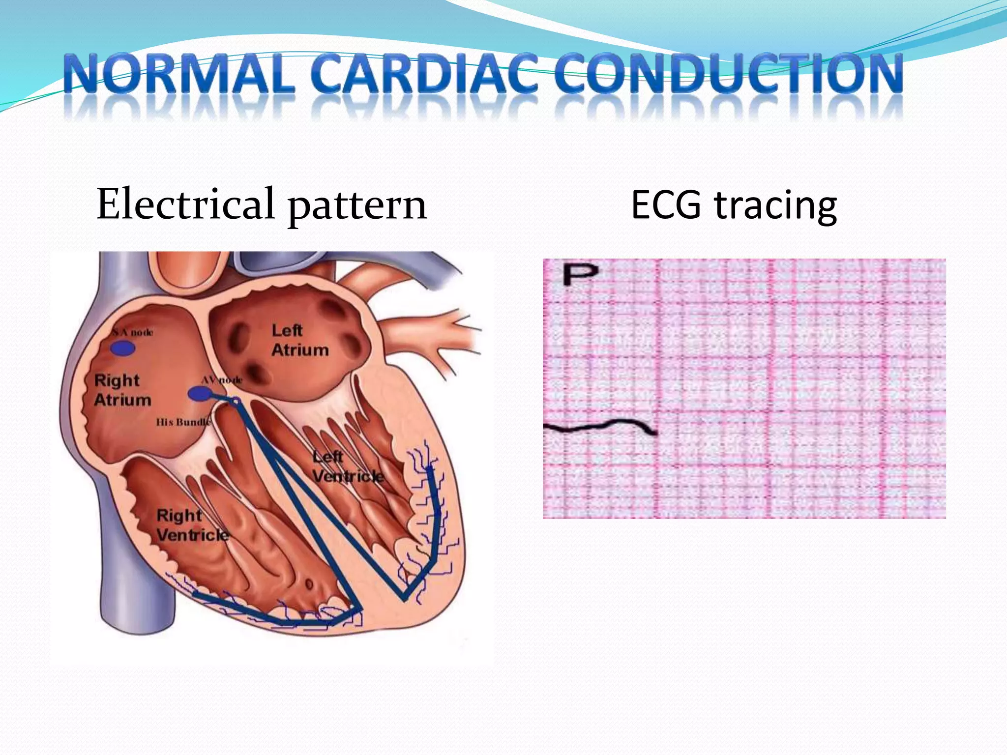 ECG tracingElectrical pattern
 