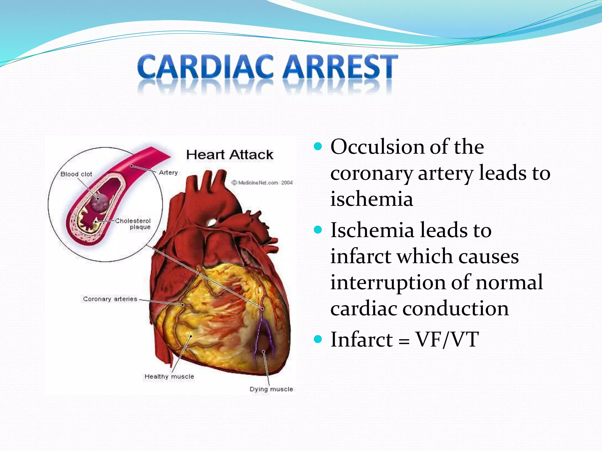  Occulsion of the
coronary artery leads to
ischemia
 Ischemia leads to
infarct which causes
interruption of normal
cardiac conduction
 Infarct = VF/VT
 