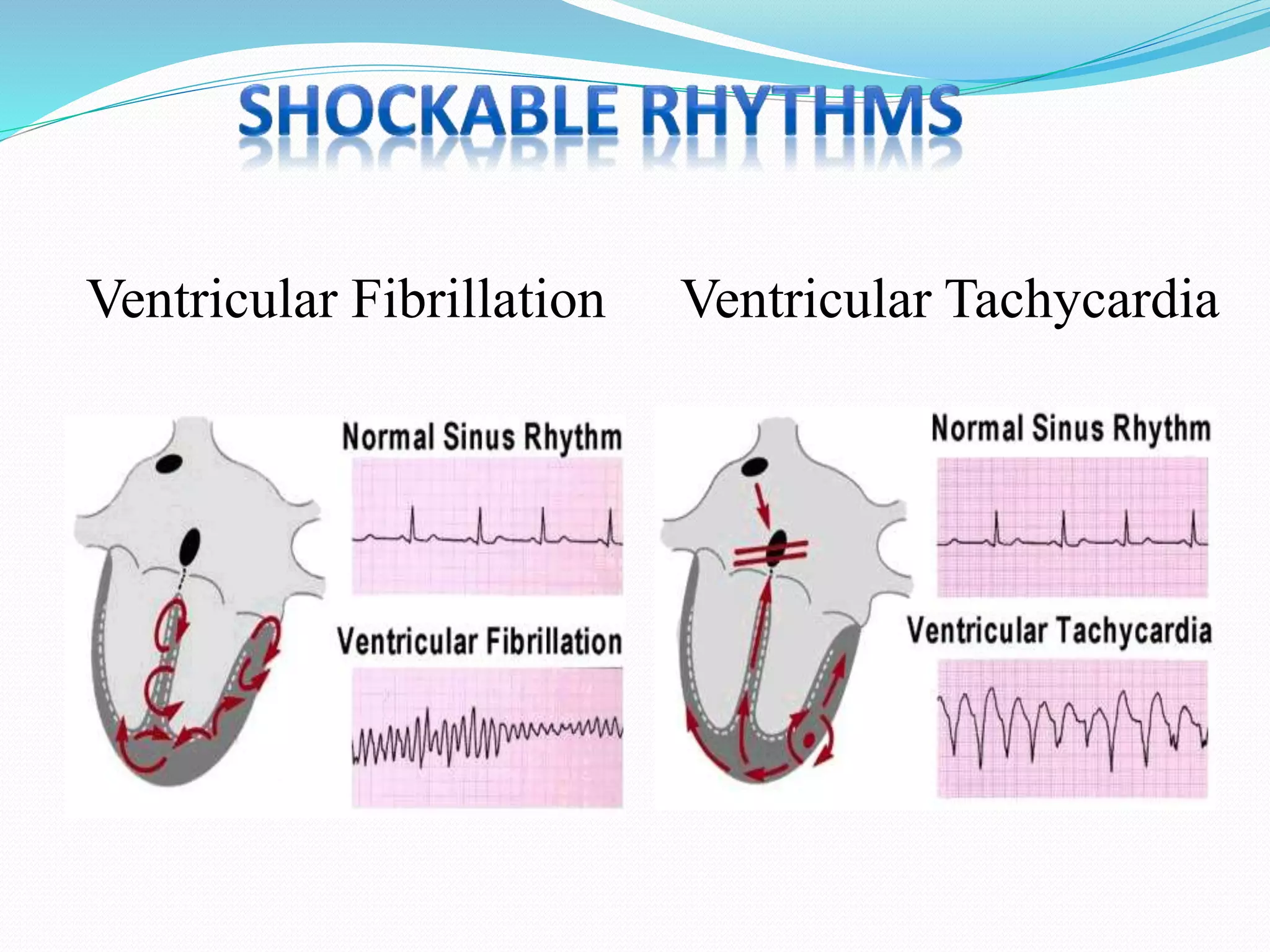 Ventricular Fibrillation Ventricular Tachycardia
 