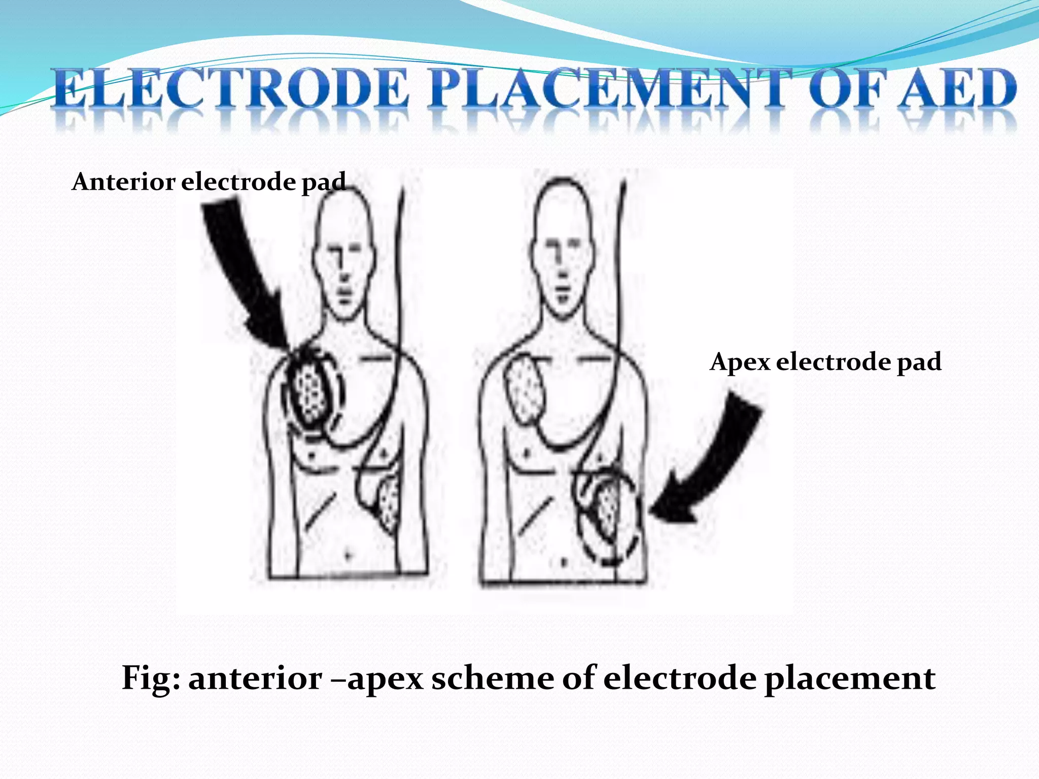 Anterior electrode pad
Apex electrode pad
Fig: anterior –apex scheme of electrode placement
 