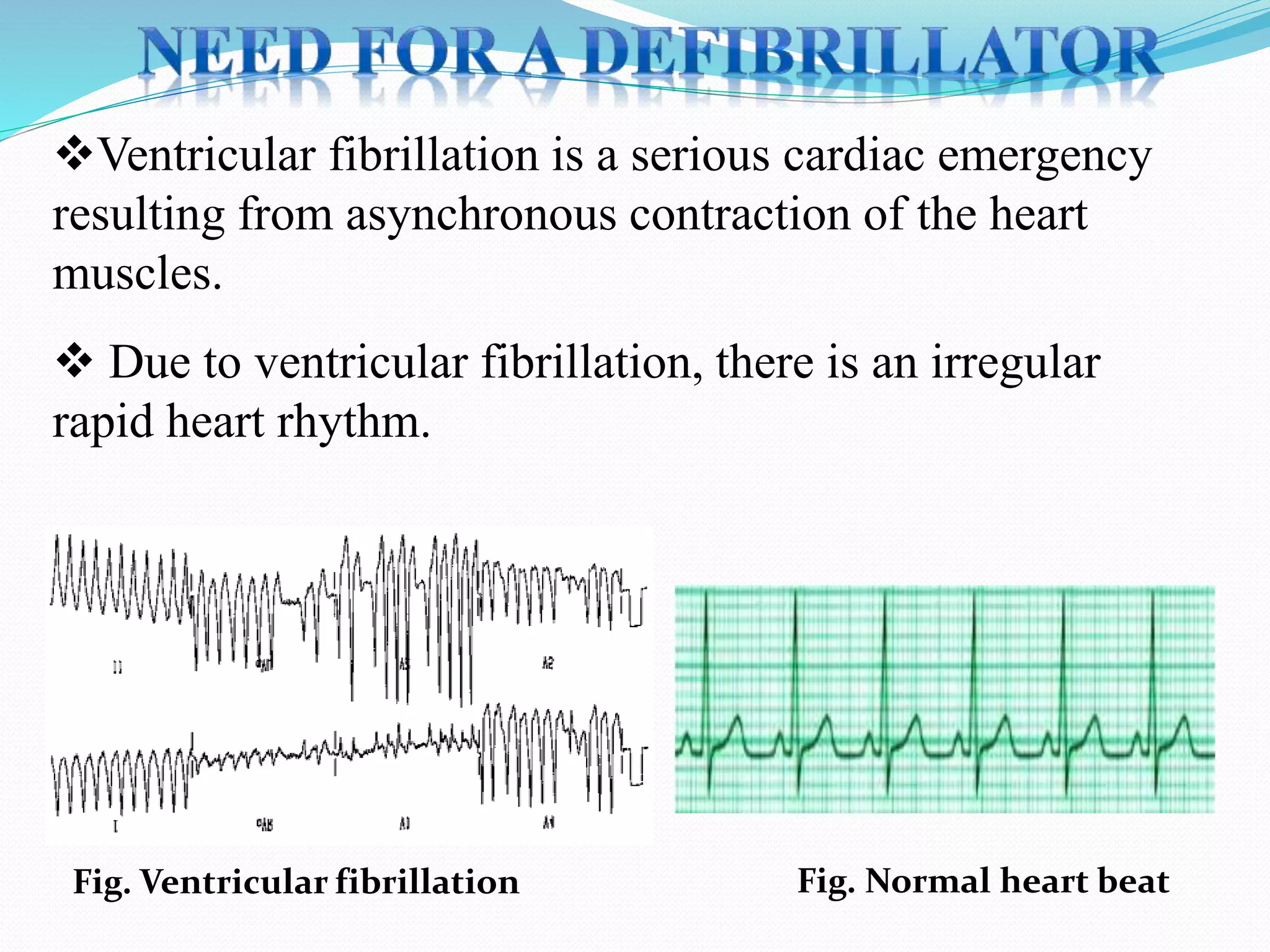 Ventricular fibrillation is a serious cardiac emergency
resulting from asynchronous contraction of the heart
muscles.
 Due to ventricular fibrillation, there is an irregular
rapid heart rhythm.
Fig. Ventricular fibrillation Fig. Normal heart beat
 