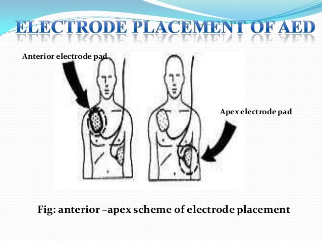 aed pad placement