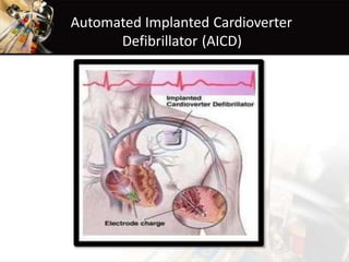 Automated Implanted Cardioverter
Defibrillator (AICD)
 