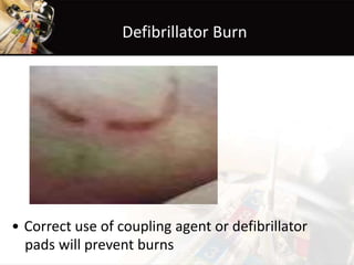 Defibrillator Burn
• Correct use of coupling agent or defibrillator
pads will prevent burns
 