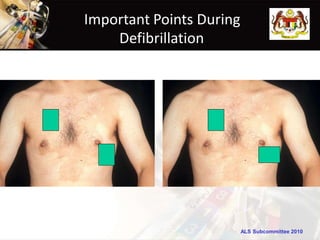 Important Points During
Defibrillation
ALS Subcommittee 2010
 