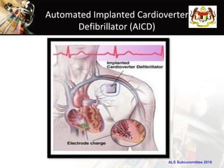 Automated Implanted Cardioverter
      Defibrillator (AICD)




                           ALS Subcommittee 2010
 