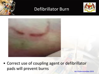 Defibrillator Burn




• Correct use of coupling agent or defibrillator
  pads will prevent burns                ALS Subcommittee 2010
 