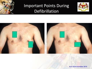 Important Points During
    Defibrillation




                          ALS Subcommittee 2010
 