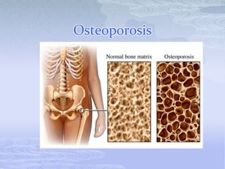 Osteoporosis