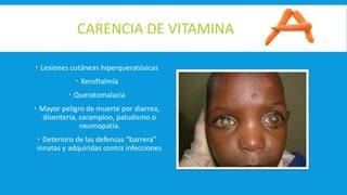 CARENCIA DE VITAMINA
 Lesiones cutáneas hiperqueratósicas
 Xeroftalmía
 Queratomalacia
 Mayor peligro de muerte por diarrea,
disenteria, sarampion, paludismo o
neumopatia.
 Deterioro de las defensas “barrera”
innatas y adquiridas contra infecciones
 