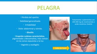 PELAGRA
 Pérdida del apetito
 Debilidad generalizada
 Irritabilidad
 Dolor abdominal y vómito.
 Glositis
 Erupción cutánea característica,
pigmentada y descamativa, más común
en las zonas expuestas a la luz.
 Vaginitis y esofagitis
Tratamiento: suplementos con
100-200 mg de nicotinamida o
acido nicotínico 3vdx5d
Collar de Casal
 