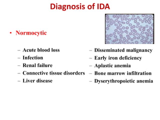 Diagnosis of IDA
• Normocytic
– Acute blood loss
– Infection
– Renal failure
– Connective tissue disorders
– Liver disease
 