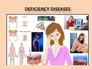 DEFICIENCY DISEASES
 