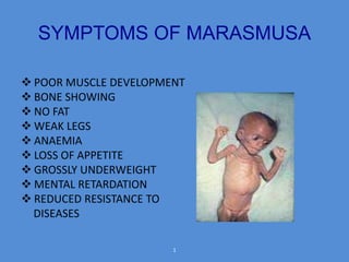 SYMPTOMS OF MARASMUSA 
 POOR MUSCLE DEVELOPMENT 
 BONE SHOWING 
 NO FAT 
 WEAK LEGS 
 ANAEMIA 
 LOSS OF APPETITE 
 GROSSLY UNDERWEIGHT 
 MENTAL RETARDATION 
 REDUCED RESISTANCE TO 
DISEASES 
1 
 