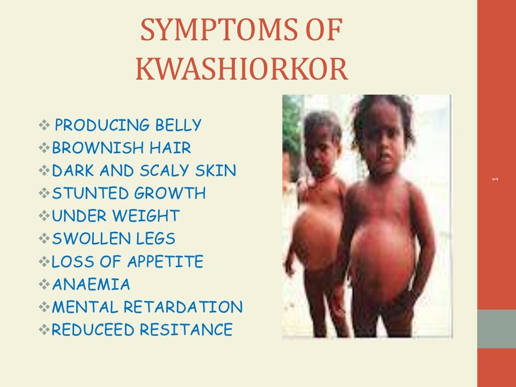 Deficiency diseases ppt by amulya s d