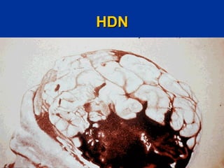 HDN
 