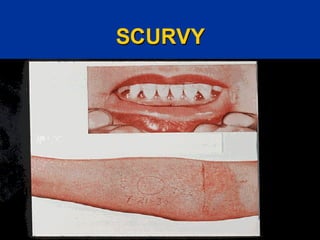 SCURVY
 