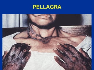 PELLAGRA
 
