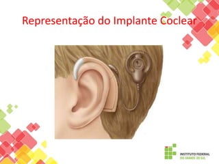 Representação do Implante Coclear
 