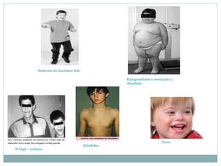 Síndrome da marionete feliz
Hipogonadismo e associação c/
obesidade
X frágil + autismo
Klinefelter
Down
 