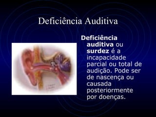 Deficiência Auditiva Deficiência auditiva  ou  surdez  é a incapacidade parcial ou total de audição. Pode ser de nascença ou causada posteriormente por doenças. 