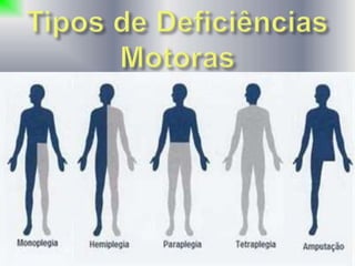 •Monoplegia
•Hemiplegia
•Paraplegia
•Tetraplegia
•Amputação
 