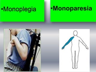 •Monoparesia
 