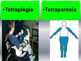 •Tetraparesia
 