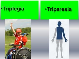 •Triplegia
 