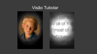 Visão Tubolar
 