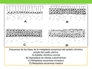 Esquemas de las fases de la metaplasia escamosa del epitelio cilíndrico
simple del cuello uterino.
A) Epitelio cilíndrico normal
B) Hiperplasia de células subcilíndricas
C) Metaplasia escamosa inmadura
D) Metaplasia escamosa madura
 