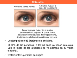 Cataratas
• Descomposición de proteínas del cristalino.
• El 30% de las personas a los 50 años ya tienen cataratas.
Sólo la mitad de los afectados se ve alterada en su visión
funcional.
• Tratamiento: Operación quirúrgica
 