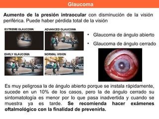 Glaucoma
• Glaucoma de ángulo abierto
• Glaucoma de ángulo cerrado
Aumento de la presión intraocular con disminución de la visión
periférica. Puede haber pérdida total de la visión
Es muy peligrosa la de ángulo abierto porque se instala rápidamente,
sucede en un 10% de los casos, pero la de ángulo cerrado su
sintomatología es menor por lo que pasa inadvertida y cuando se
muestra ya es tarde. Se recomienda hacer exámenes
oftalmológico con la finalidad de prevenirla.
 